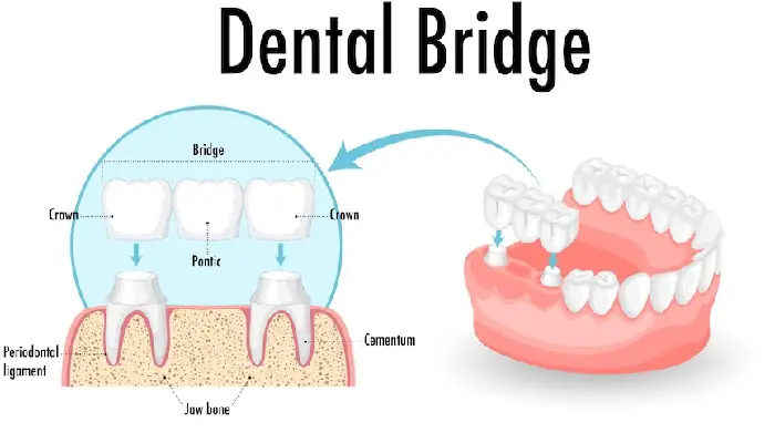 all on 4 dental implants pembroke pines