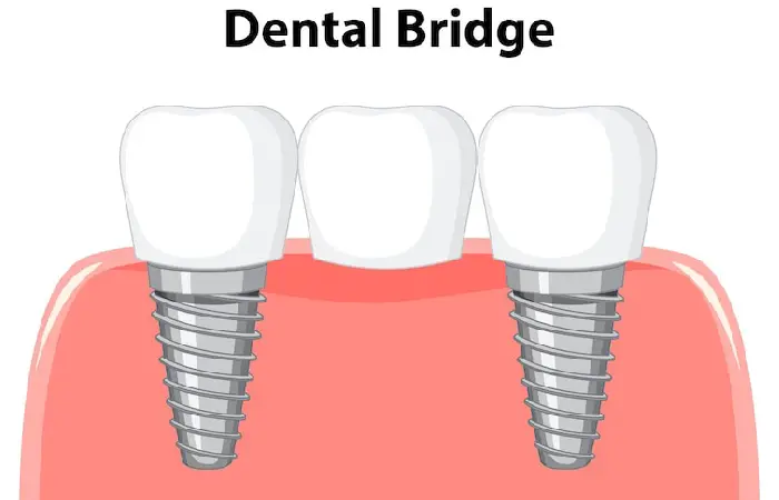 all on 4 dental implants pembroke pines